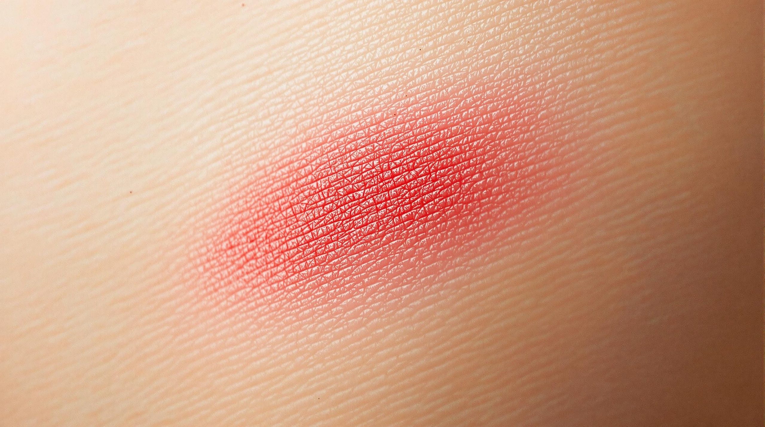 Cicatrice rouge : que faire ?