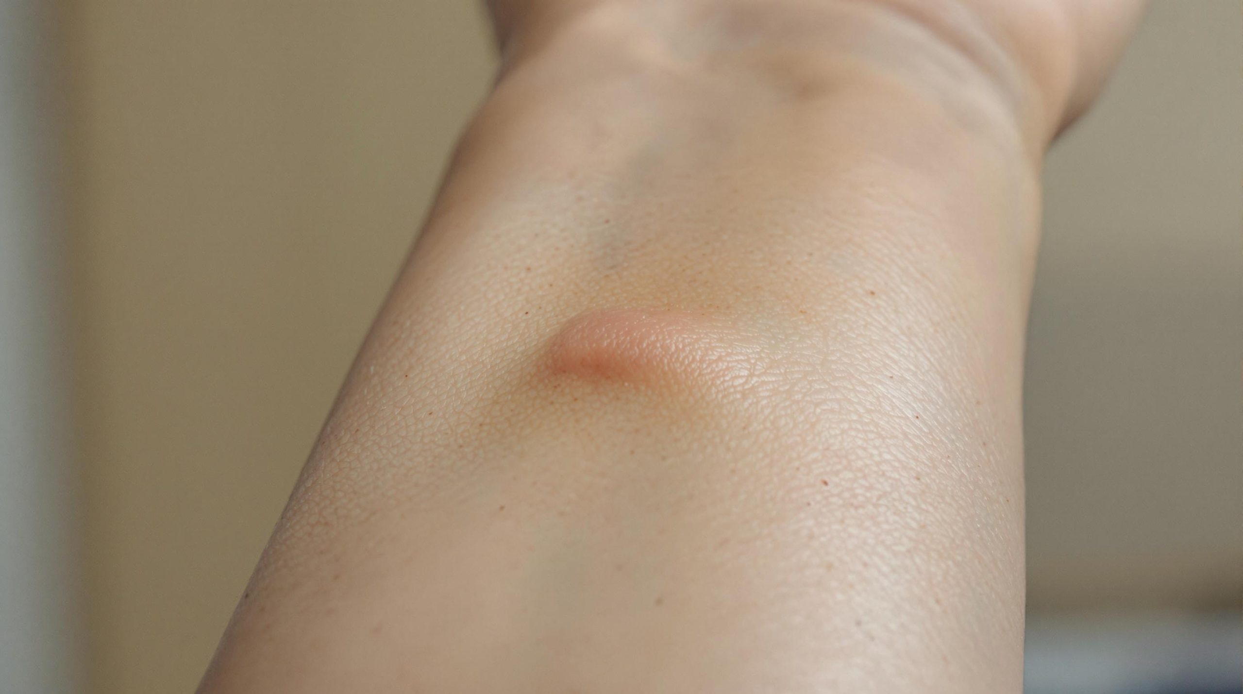 Vieille cicatrice qui gonfle : causes, traitements et conseils
